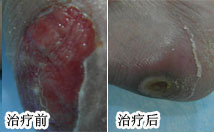 贾俊(化名)足病病例 
