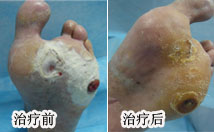 刘二喜(化名)足病病例 