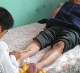 李大爷足病治疗案例